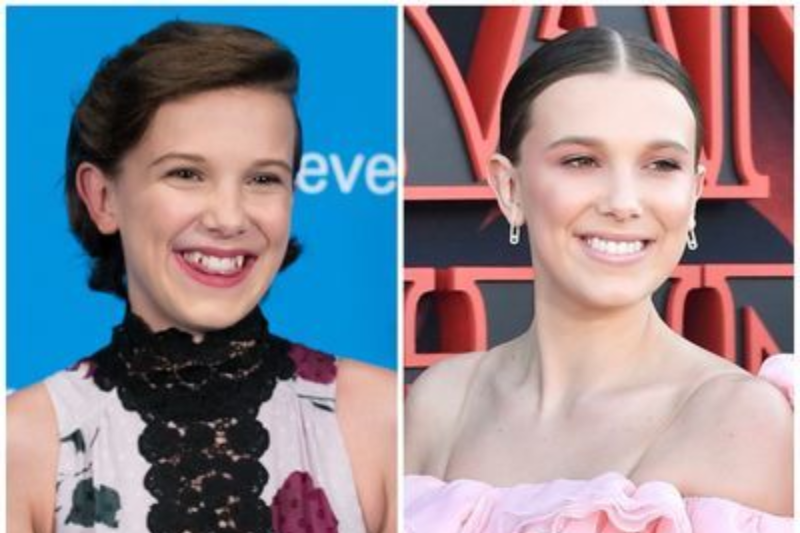Millie Bobby Brown Plastic Surgery: What’s Real and What’s Rumor